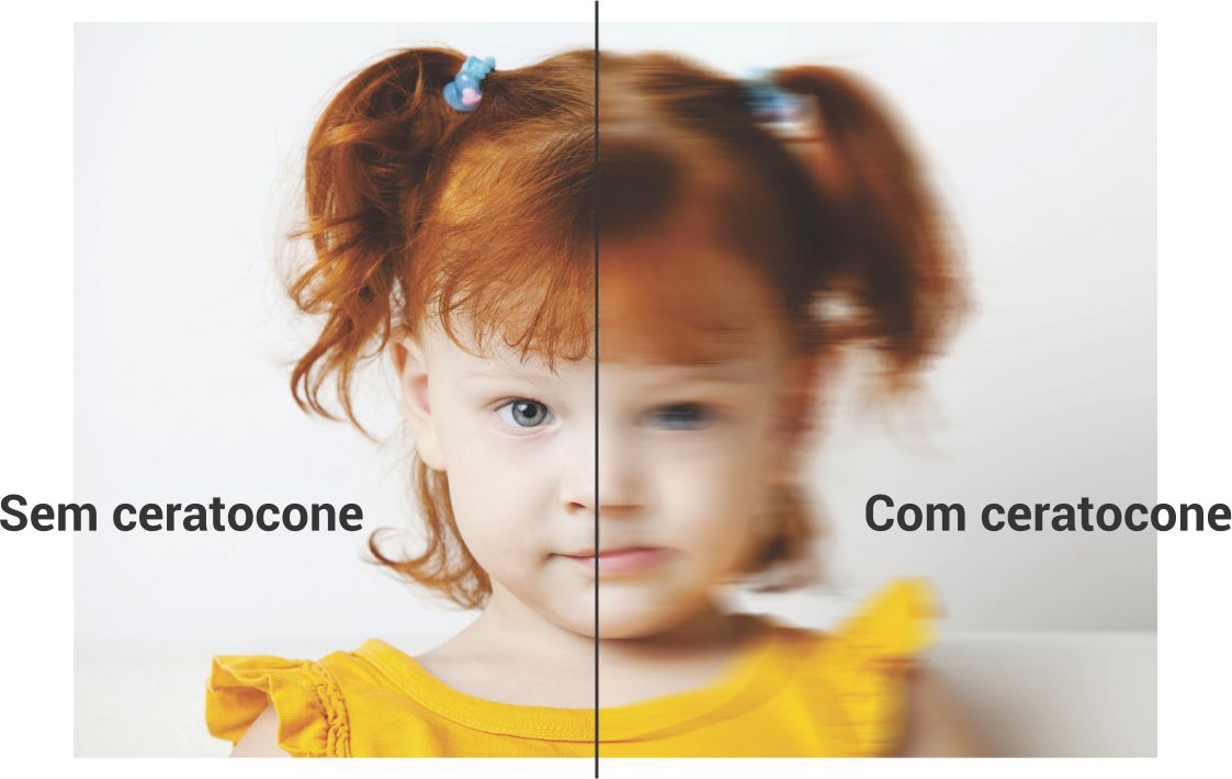Como o ceratocone afeta a visão