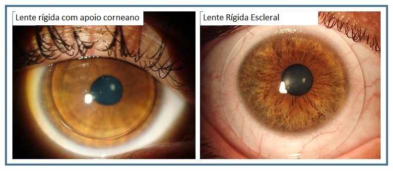 Lente de contato rígida para ceratocone