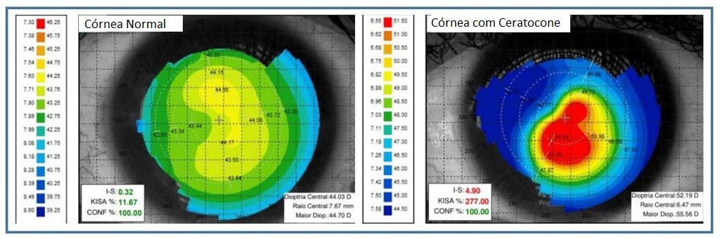 Topografia corneana com ceratocone