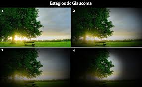 Glaucoma: o "ladrão silencioso" da visão
