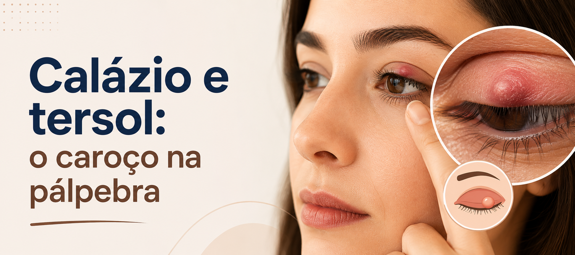 Calázio e tersol: o caroço na pálpebra