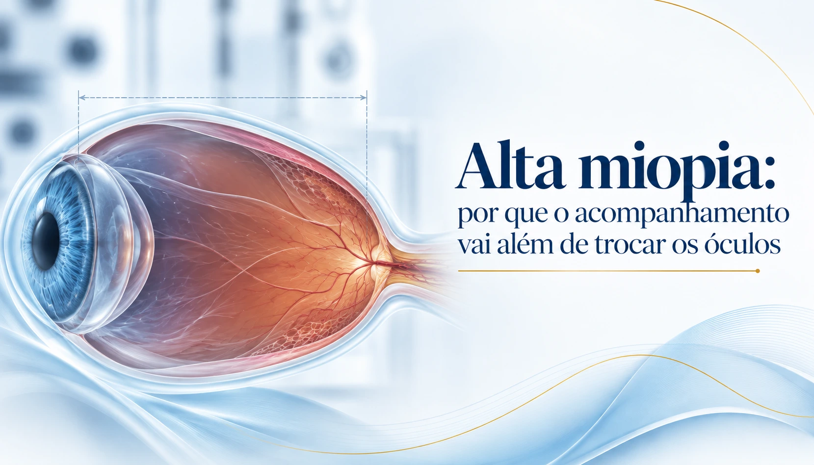 Alta miopia: por que o acompanhamento vai além de trocar os óculos