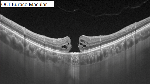 Buraco Macular