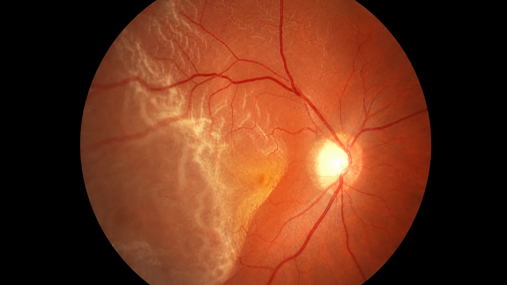 Descolamento de Retina